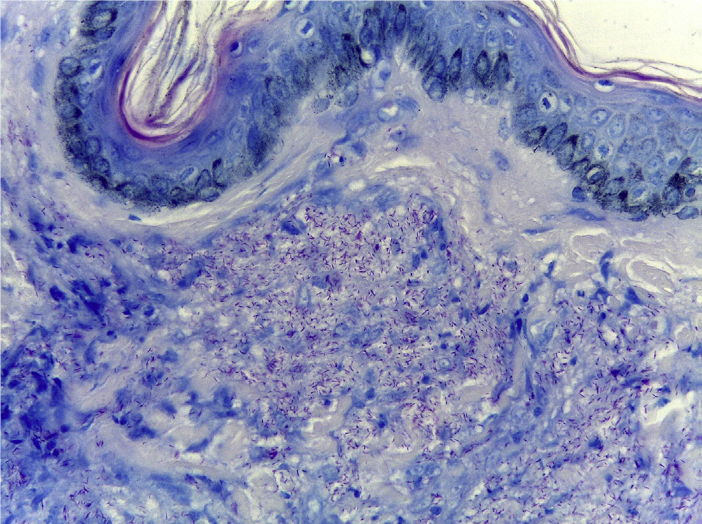 Lepra - Dr. Esteban Castro - Médico Traumatólogo Ortopédista | Cirugía de columna y articular