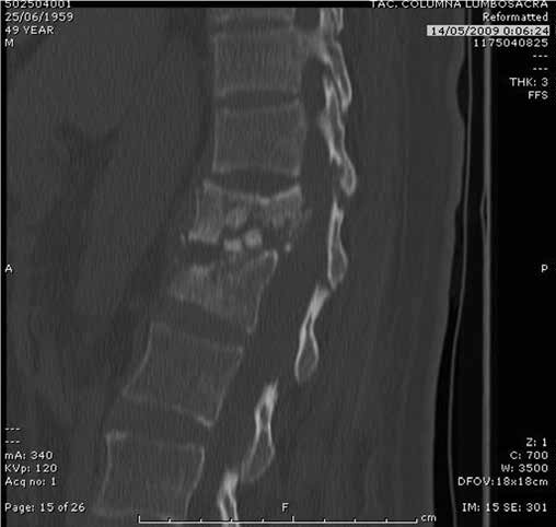 Hidatidosis vertebral - Dr. Esteban Castro - Médico Traumatólogo Ortopédista | Cirugía de columna y articular
