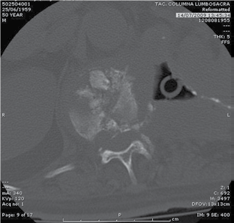 Hidatidosis vertebral - Dr. Esteban Castro - Médico Traumatólogo Ortopédista | Cirugía de columna y articular