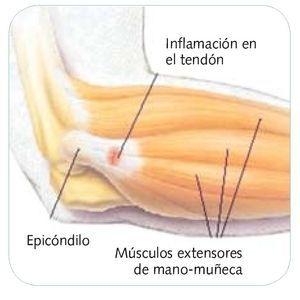 Epicondilitis lateral - Dr. Esteban Castro - Médico Traumatólogo Ortopédista | Cirugía de columna y articular