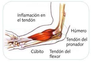 Epitrocleitis - Inflamación de la inserción tendinosa de los músculos flexores de la muñeca y de los dedos a nivel de la epitróclea Epitrocleitis - Dr. Esteban Castro - Médico Traumatólogo Ortopédista | Cirugía de columna y articular
