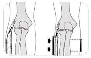 Epitrocleitis