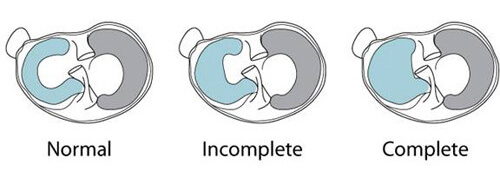 Menisco discoide en niños y adolescentes - Menisco discoide en niños y adolescentes: correlación entre la morfología y la presencia de lesiones Menisco discoide en niños y adolescentes