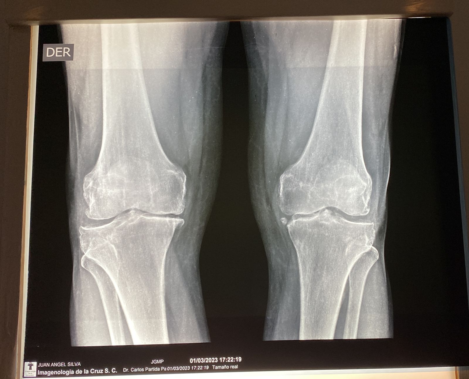 Que es el desgaste de rodilla o gonartrosis - Dr. Esteban Castro - Médico Traumatólogo Ortopédista | Cirugía de columna y articular
