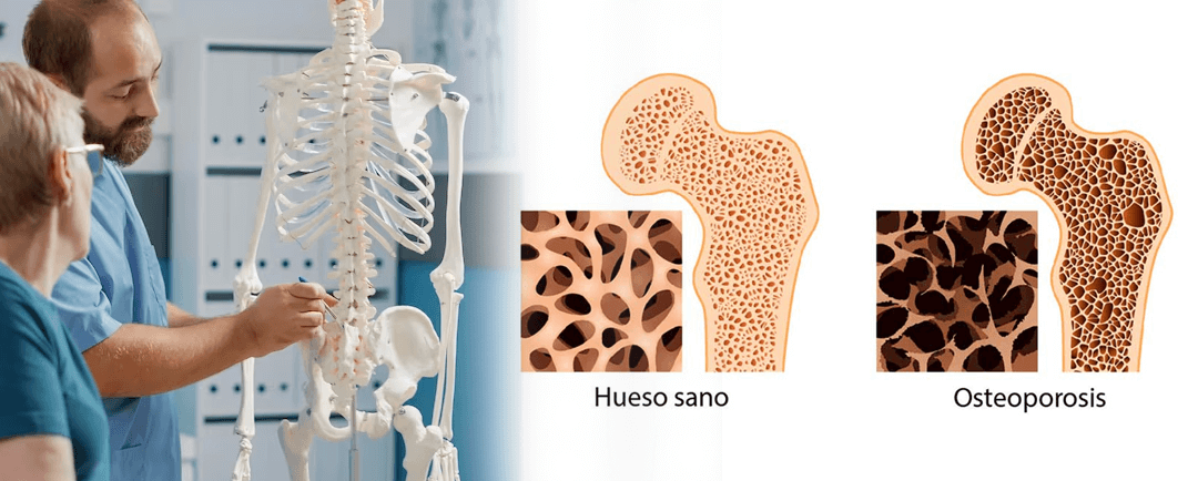 Consecuencias de la osteoporosis - Dr. Esteban Castro - Médico Traumatólogo Ortopédista | Cirugía de columna y articular